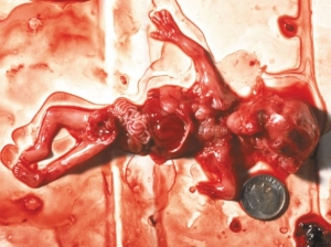 aborted-baby-2